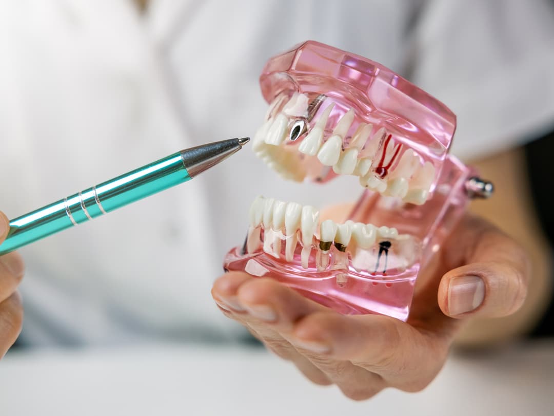 Implantes en Ferrol - técnicas innovadoras Centro Dental San Pablo
