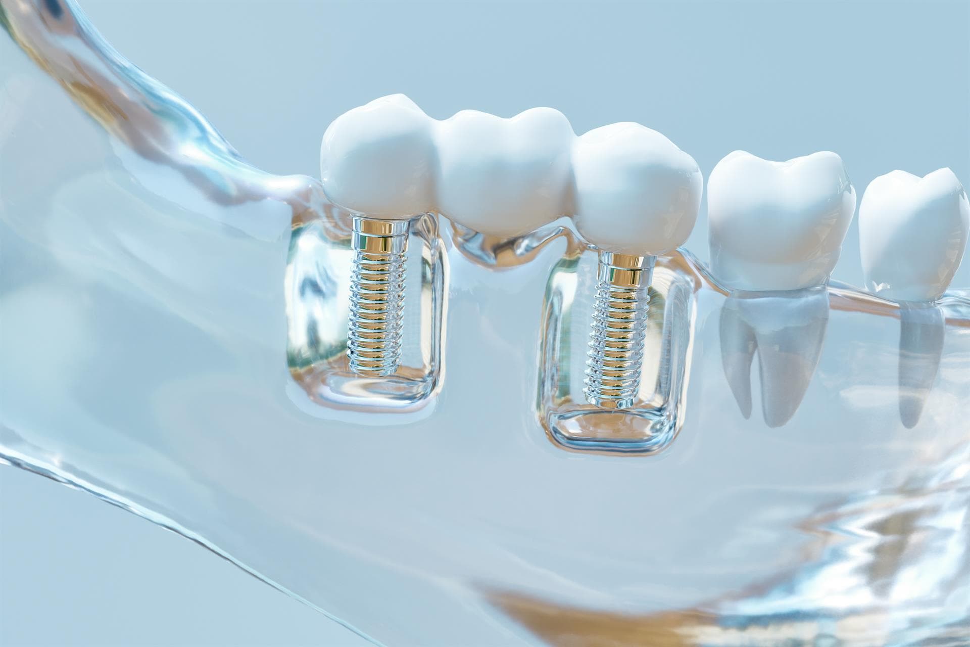 Precio implante dental en Ferrol - Centro Dental San Pablo