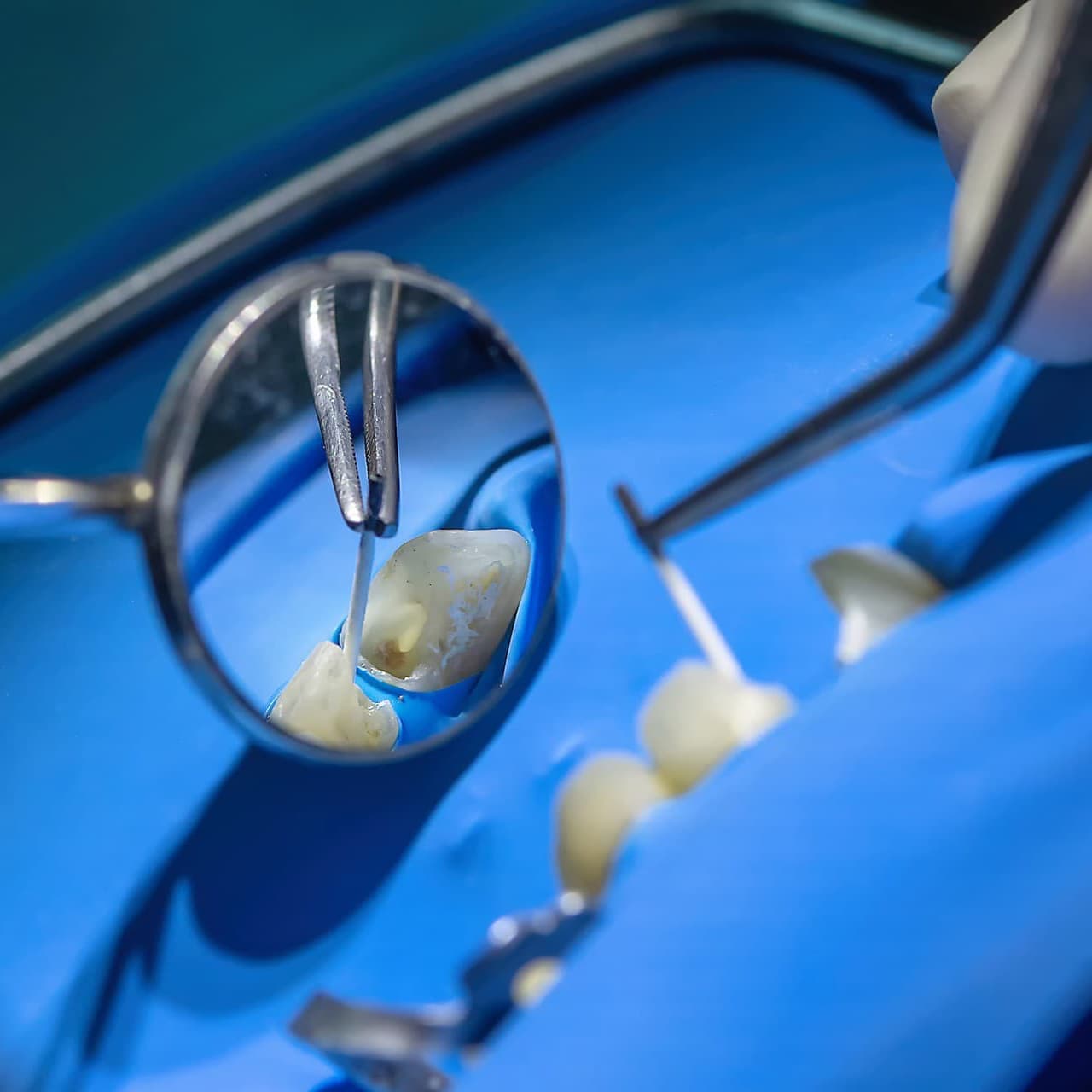 Tratamiento de endodoncia en Ferrol - Centro Dental San Pablo