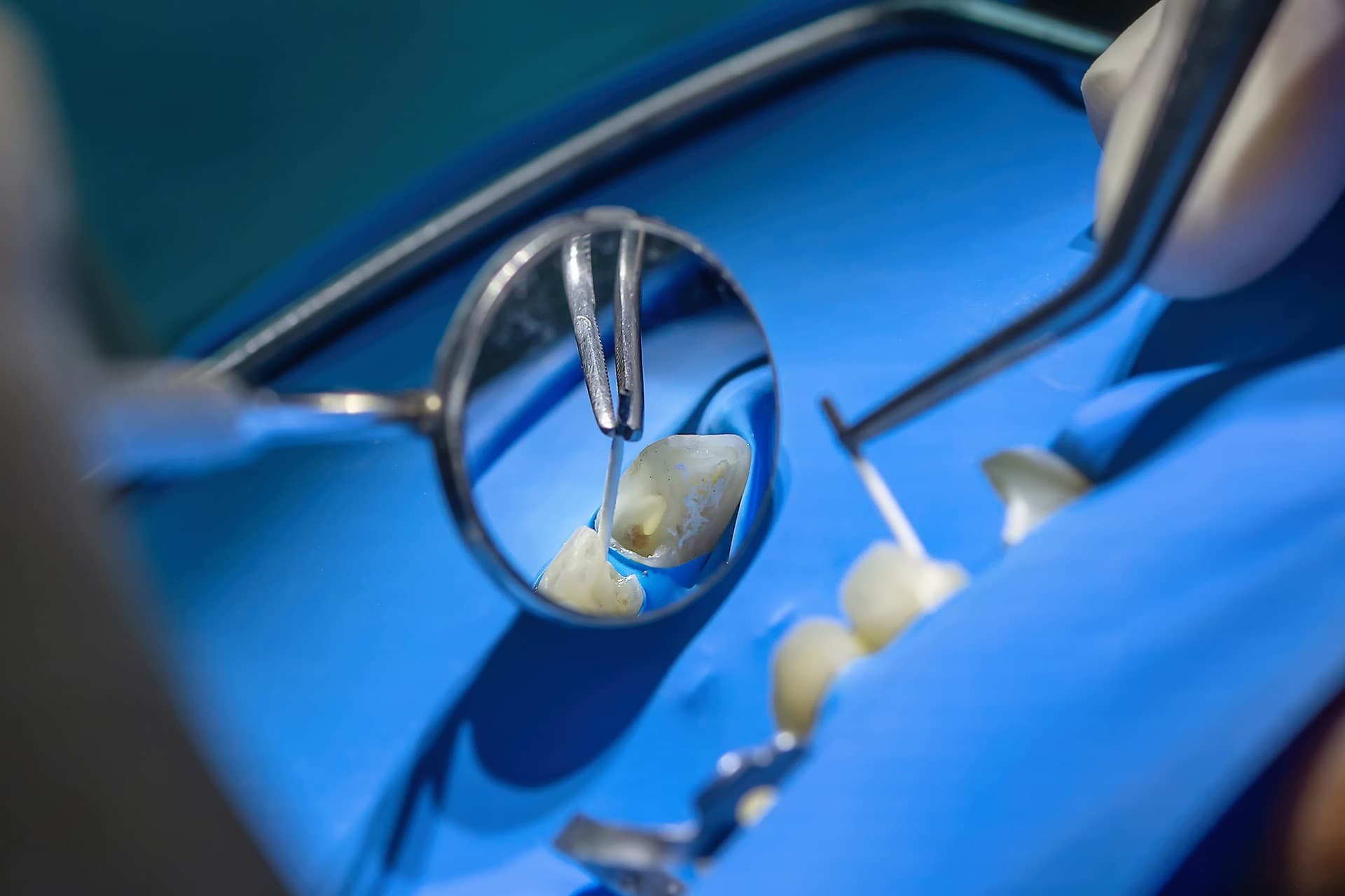 Endodoncia en Ferrol